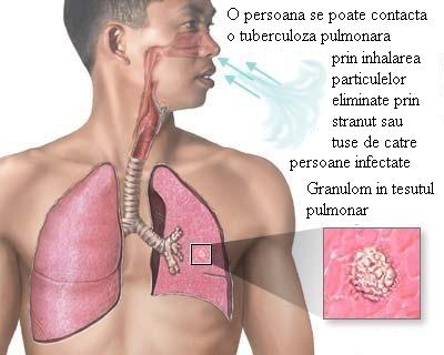 imagini tuberculoza pulmonara